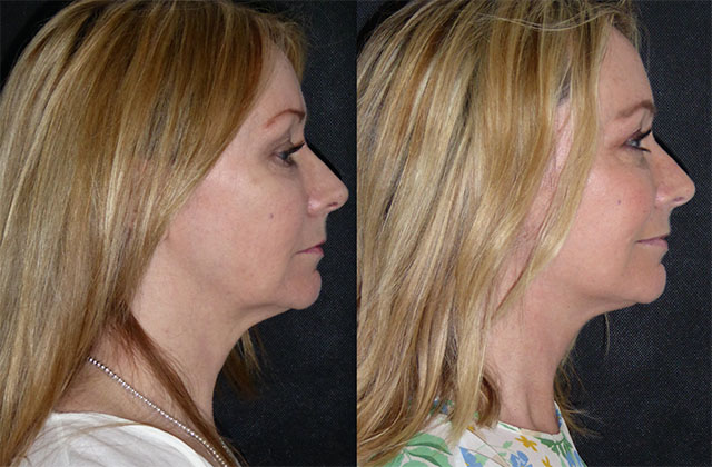 Kim 55; Facelift, Neck lift surgery