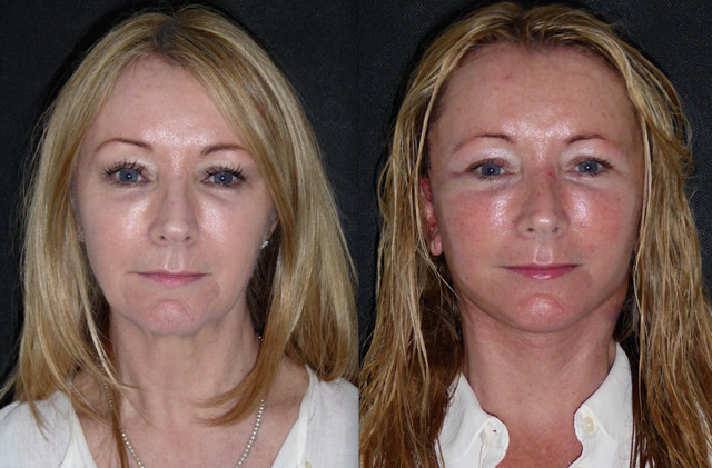 Kim 55; Facelift, Neck lift surgery