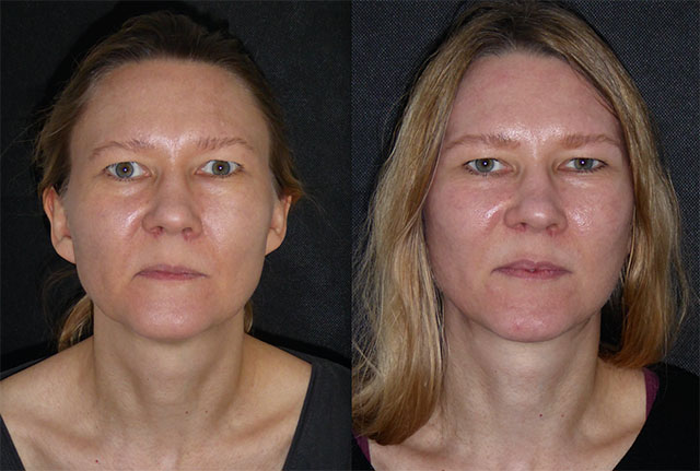 max-44-facelift-neck-lift-brow-lift-surgery - Dominic Bray