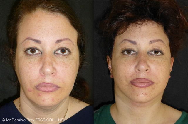 Facelift, Neck, Liposuction, 39 Years Old