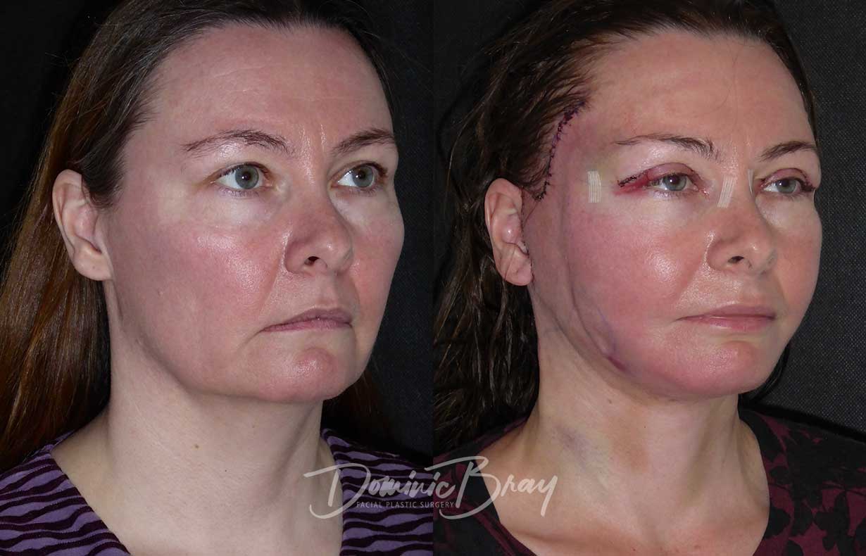 Jacqui, 44 | 34-44, Brow, Eyelid Surgery, Eyes, Face & Necklift, Jowls ...