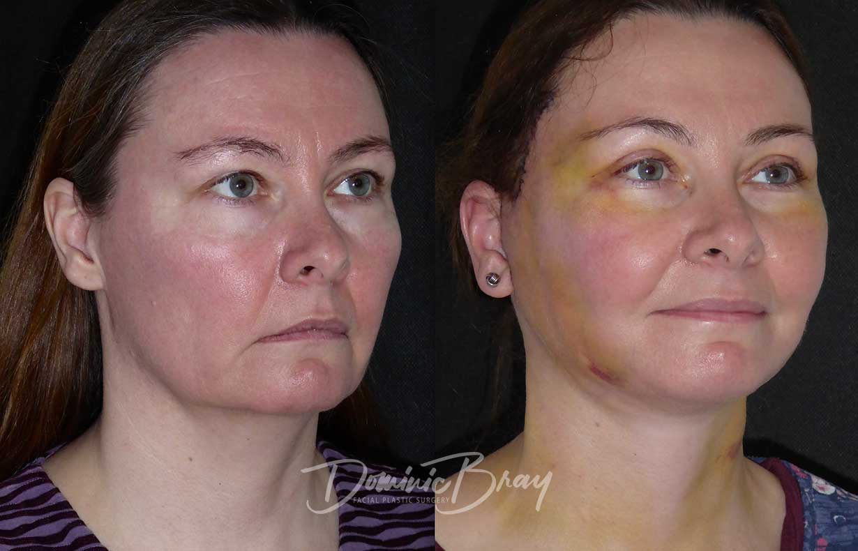 Jacqui, 44 | 34-44, Brow, Eyelid Surgery, Eyes, Face & Necklift, Jowls ...