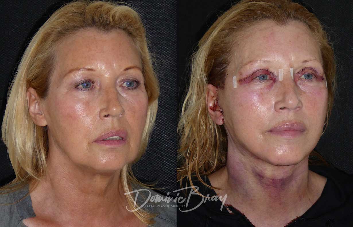 Maureen, 62 | 55-64, Eyelid Surgery, Eyes, Face & Necklift, Jowls ...