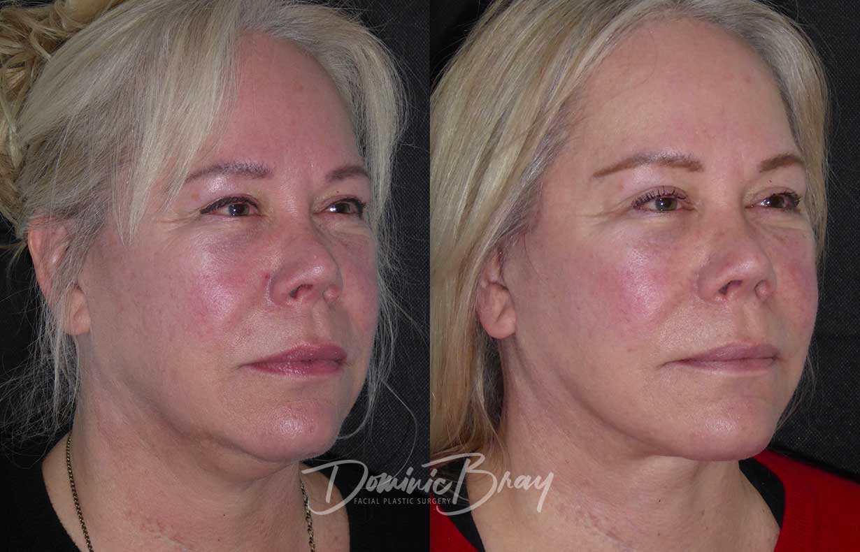 Sharon, 58 | 55-64, Face & Necklift, Jowls, Liposculpture, Neck | Dr ...